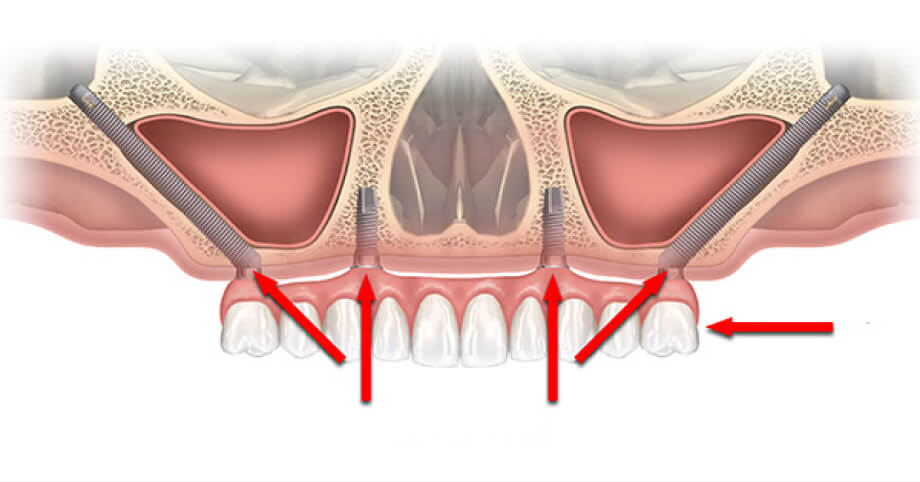 Имплантация зубов без костной пластики mobile