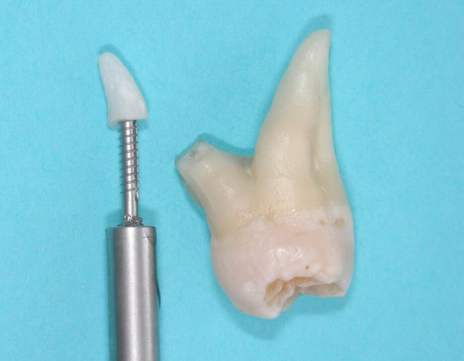 Удаление корня зуба mobile