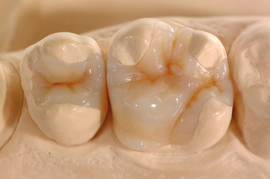 Реставрация зубов керамическими вкладками