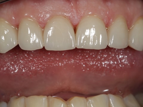 Фото зубов после установки виниров
