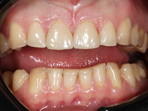 Фото зубов после установки виниров