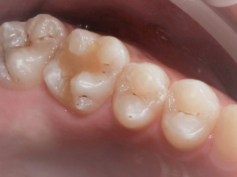 Фото до восстановления зубов