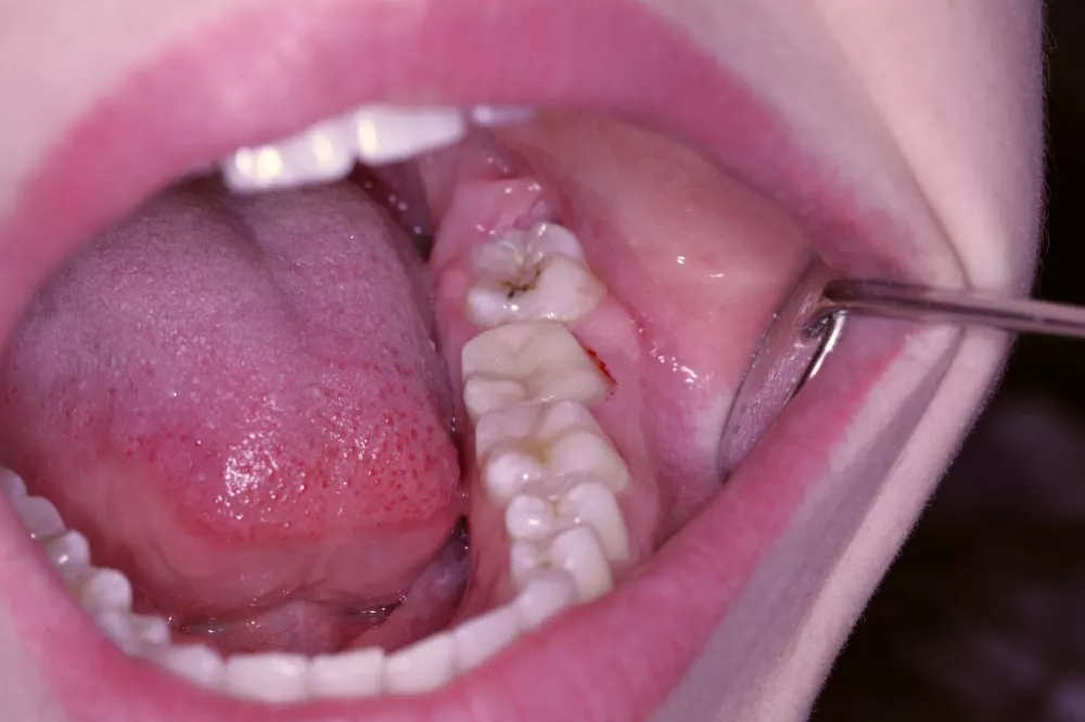 Отреставрированный зуб