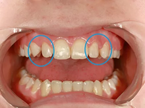 Неправильный прикус и аномалия положения и размеров зубов