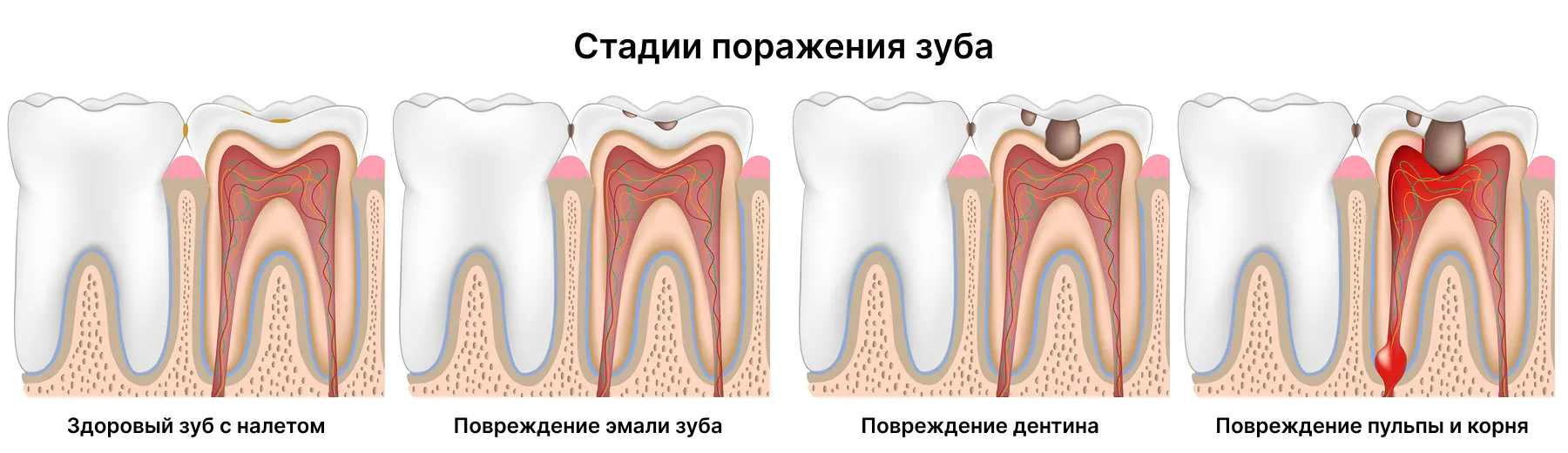 стадии разрушения и повреждения зуба
