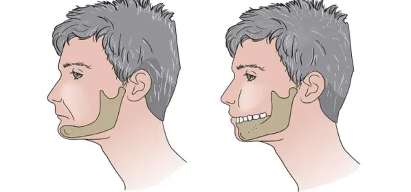 асимметрия лица без зубов