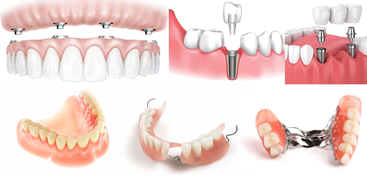 Способы восстановления зубного ряда