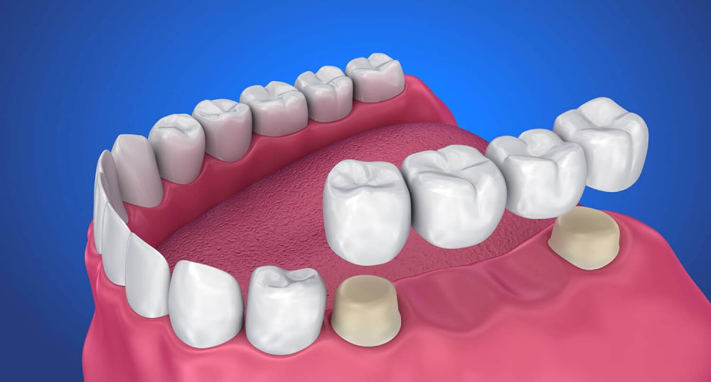 Протезирование на соседних зубах