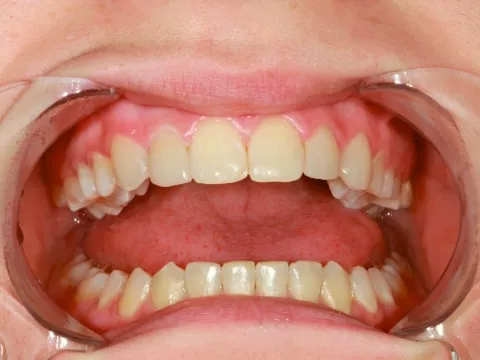 Зубы после исправления прикуса и виниринга