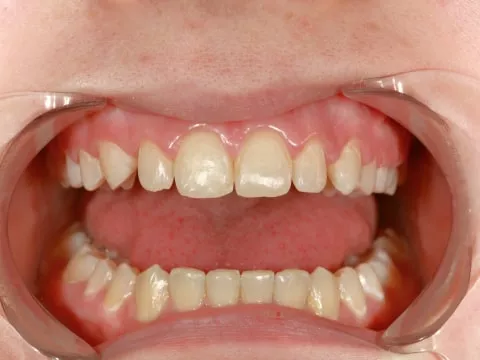 Аномалии размера и положения зубов 
