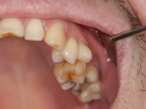 Аномальный зуб перед удалением