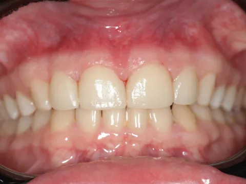 Фото протезированных зубов