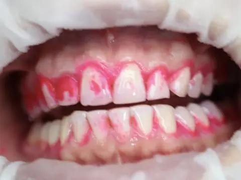 Фото зубов с гель-тестом