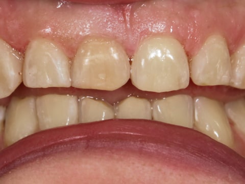 Фото зубов до установки виниров