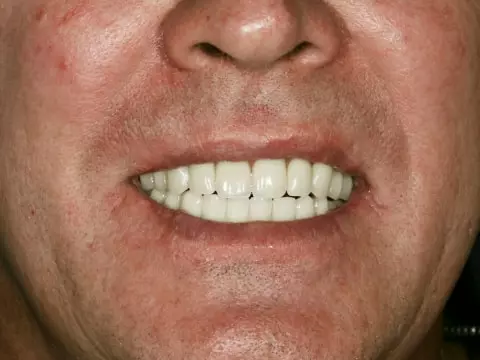 Фото после имплантации зубов