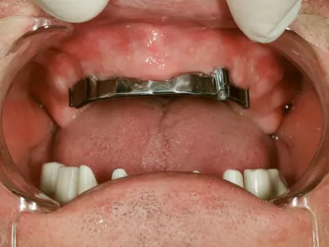 Фото зубов до имплантации