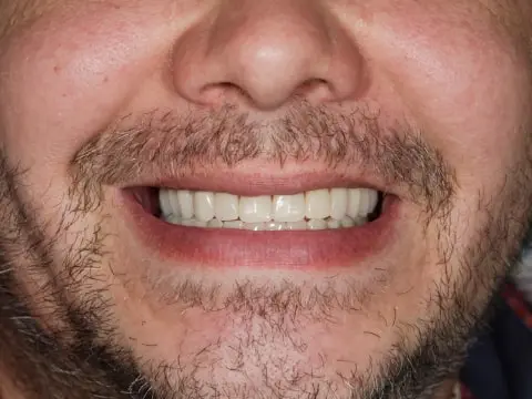 Фото протезированных зубов