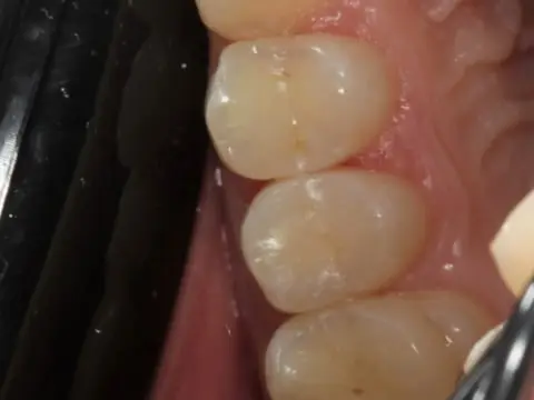 Восстановленные после кариеса зубы