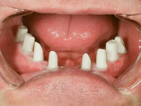 Пример имплантации зубов
