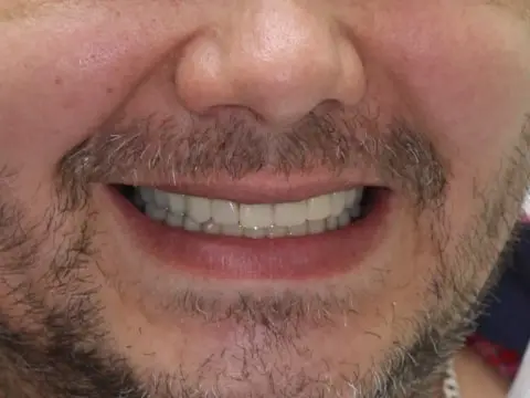 Новые зубы