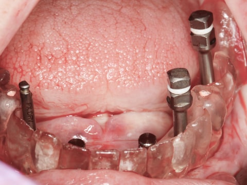 Установка имплантов стоматология
