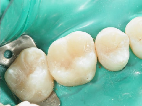 Восстановление зубов пломбой