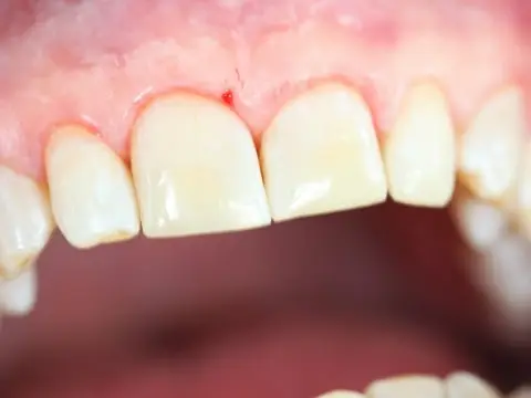 После реставрации зубов