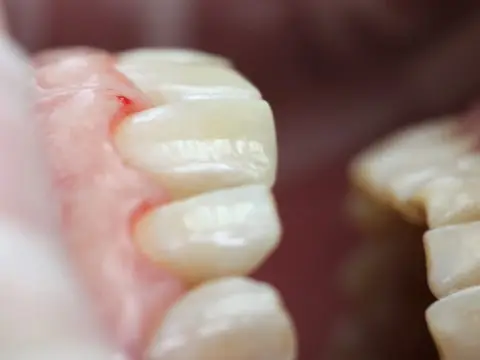 Отреставрированные зубы