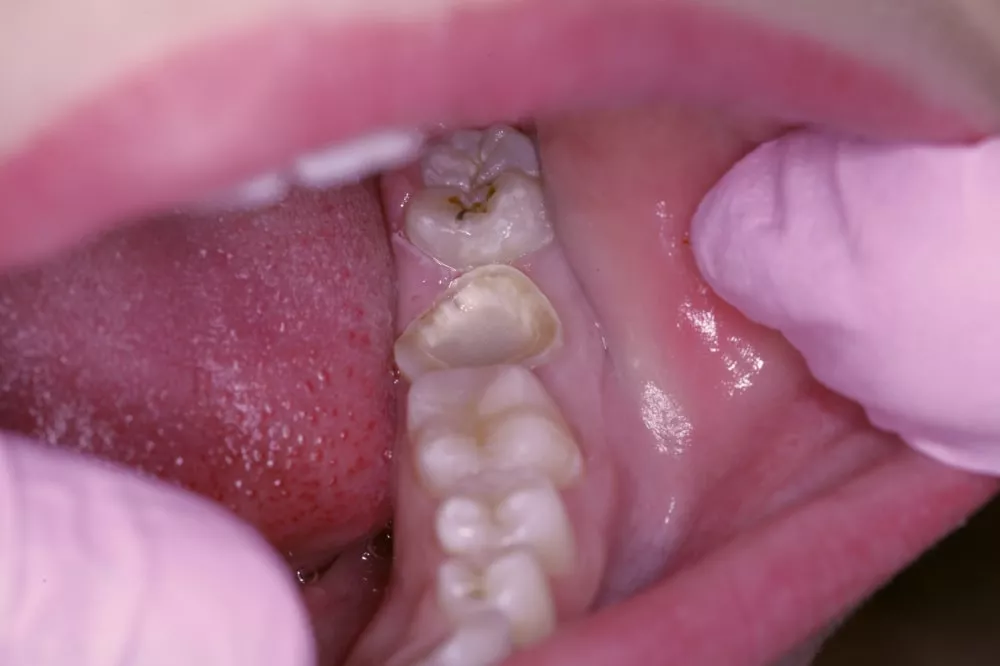 Поврежденная коронка зуба