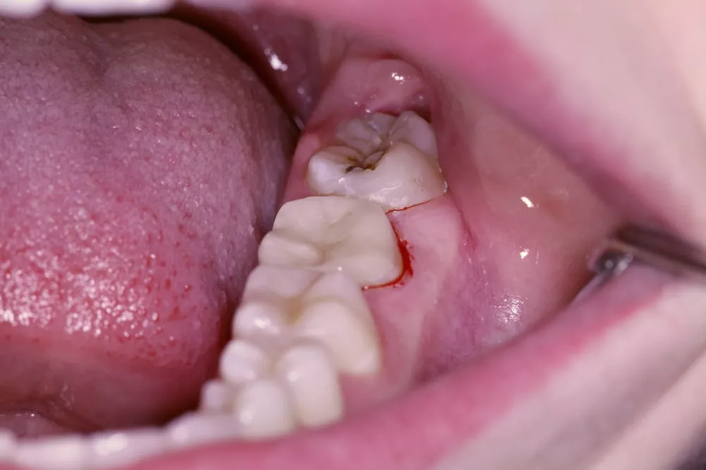 Керамическая вкладка на зуб