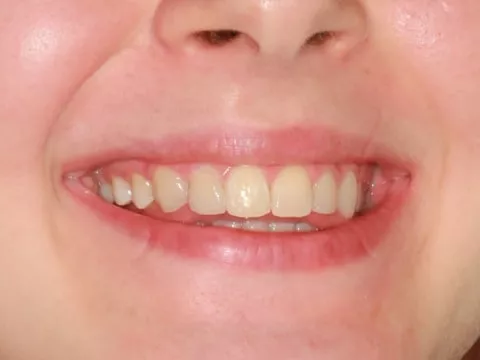 Зубы с винирами