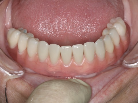 Восстановленный зубной ряд нижней челюсти
