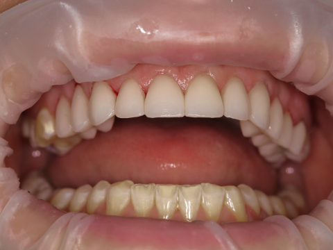 восстановление зубов верхней челюсти винирами
