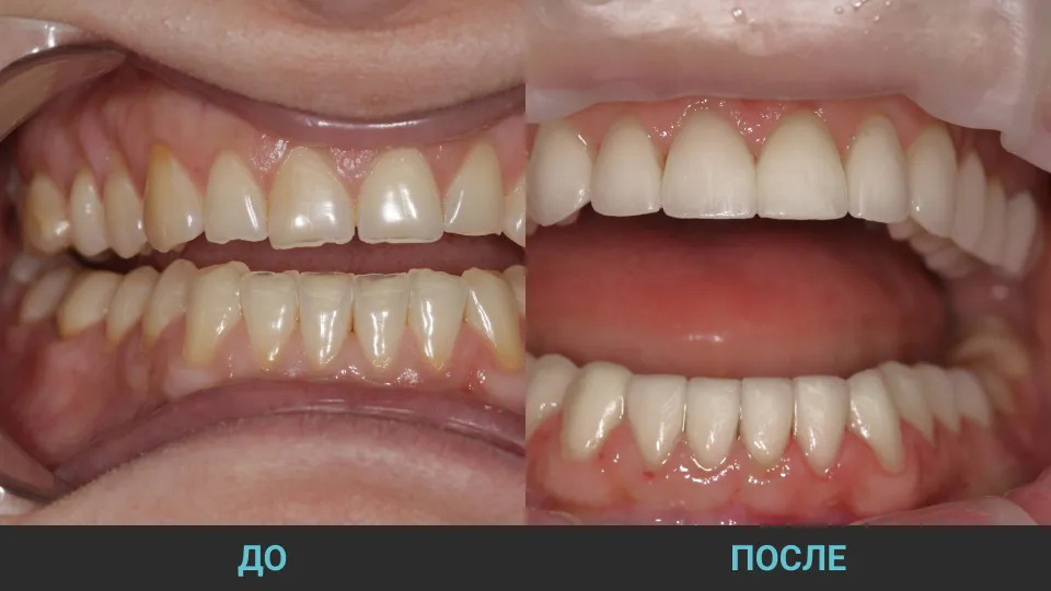 до-после восстановления зубов винирами