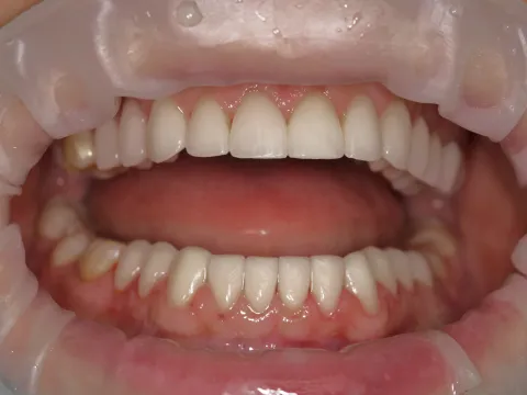 восстановление зубов винирами и коронками