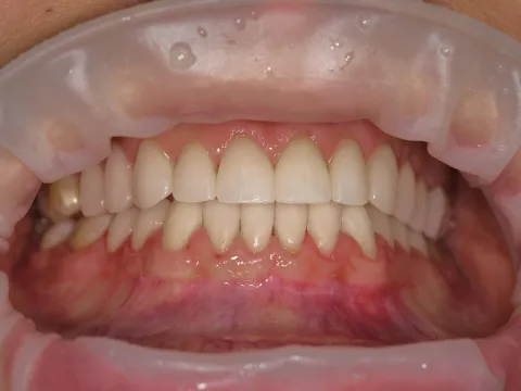 фото восстановленных винирами зубов
