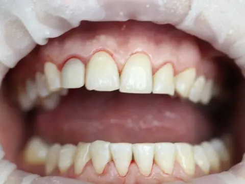 Зубы после профессиональной гигиены