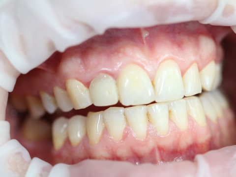 После чистки зубов у стоматолога